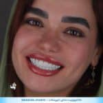 کامپوزیت 52