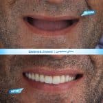پروتز ثابت و متحرک 01