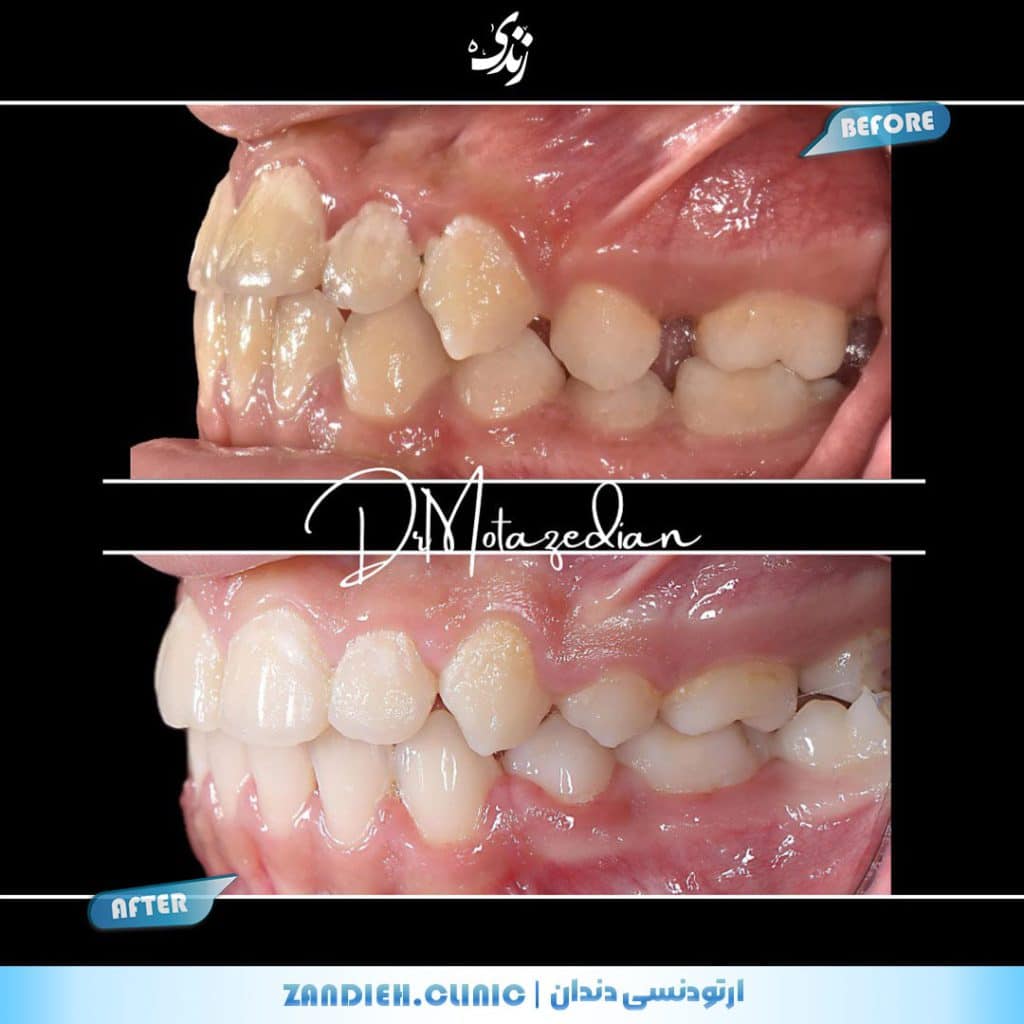 اصلاح فک و دندانها با ارتودنسی در کلینیک زندیه