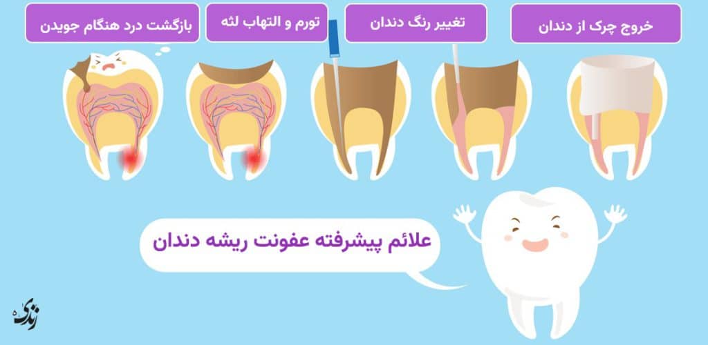 بررسی علائم پیشرفته عفونت ریشه دندان