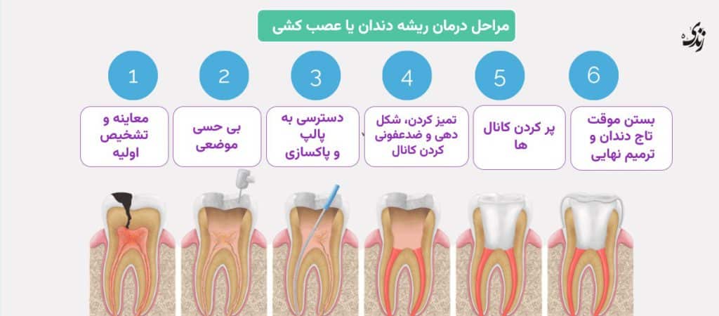 مراحل درمان ریشه دندان یا عصب کشی