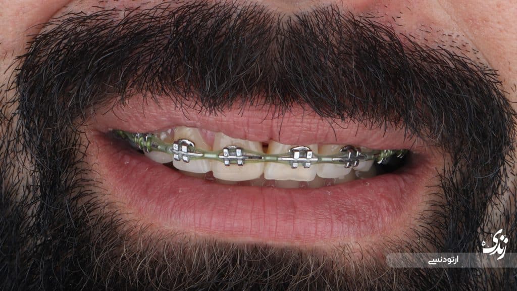 نمونه کار واقعی ارتودنسی