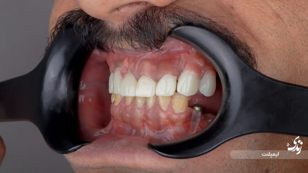 نمونه کار ایمپلنت توسط کلینیک دندانپزشکی زندیه