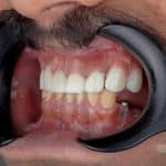 ایمپلنت020