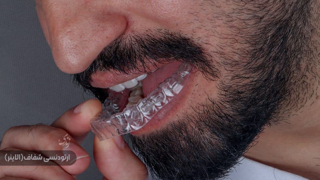 عکس واقعی ارتودنسی در کلینیک دندانپزشکی زندیه