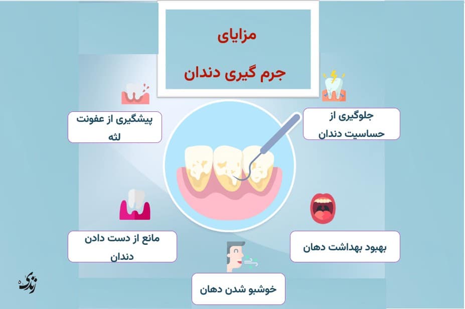 مزایای جرم گیری دندان
