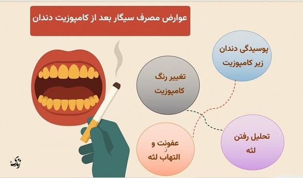 بررسی عوارض مصرف سیگار بعد از کامپوزیت دندان