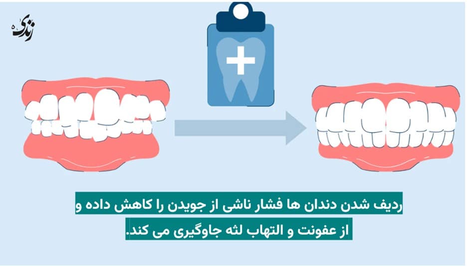 مزیت ردیف کردن دندان ها