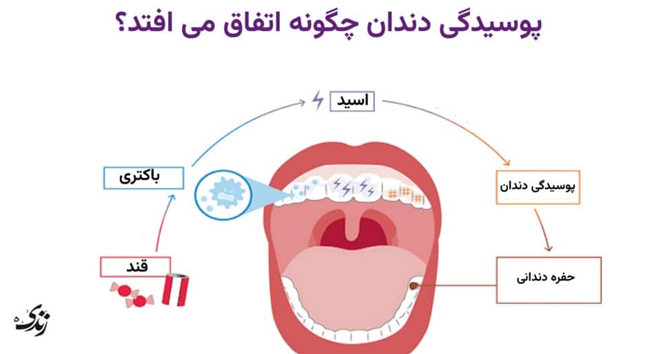 پوسیدگی دندان چطور رخ می هد؟