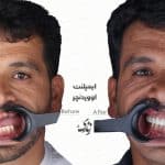 ایمپلنت 022