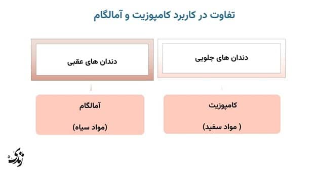 بررسی کاربرد کامپوزیت و آمالگام