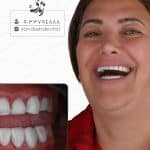 لمینت 23