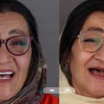 نمونه کار ایمپلنت دندان کلینیک زندیه 02۸