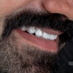 نمونه کار لمینت دندان کلینیک زندیه 31