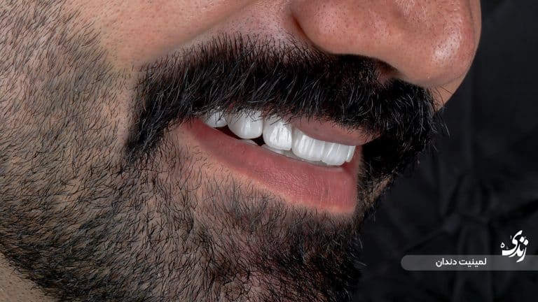 نمونه کار لمینت دندان کلینیک زندیه