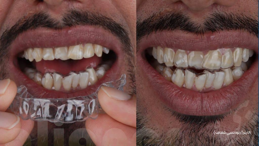 بررسی ارتودنسی شفاف