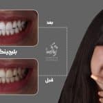 نمونه کار بلیچینگ دندان 030