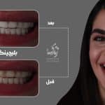 نمونه کار بلیچینگ دندان 031