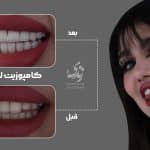 نمونه کار کامپوزیت دندان 95