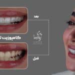 نمونه کار کامپوزیت دندان 96