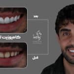 نمونه کار کامپوزیت دندان 97