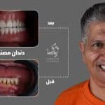 نمونه کار دندان مصنوعی 026