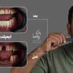 نمونه کار ایمپلنت دندان 029