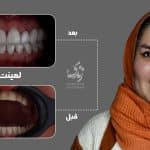 نمونه کار لمینت دندان کلینیک زندیه 33