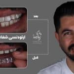 نمونه کار ارتودنسی دندان54