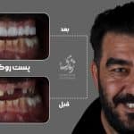 نمونه کار روکش دندان 11