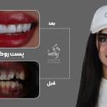 نمونه کار روکش دندان 12
