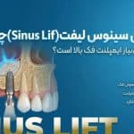 جراحی سینوس لیفت (Sinus Lift)؛ پیشنیاز مهم ایمپلنت فک بالا