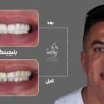 نمونه کار بلیچینگ دندان 032