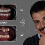 نمونه کار ایمپلنت دندان 030