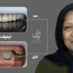 نمونه کار ایمپلنت دندان 031