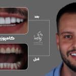 نمونه کار کامپوزیت دندان 98