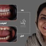 نمونه کار لمینت دندان کلینیک زندیه 34