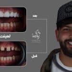 نمونه کار لمینت دندان کلینیک زندیه 36