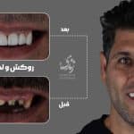 نمونه کار روکش و لمینت دندان
