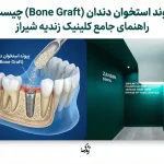 پیوند استخوان دندان (Bone Graft) چیست؟ راهنمای جامع