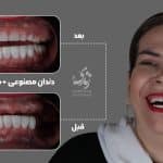 نمونه کار دندان مصنوعی 029