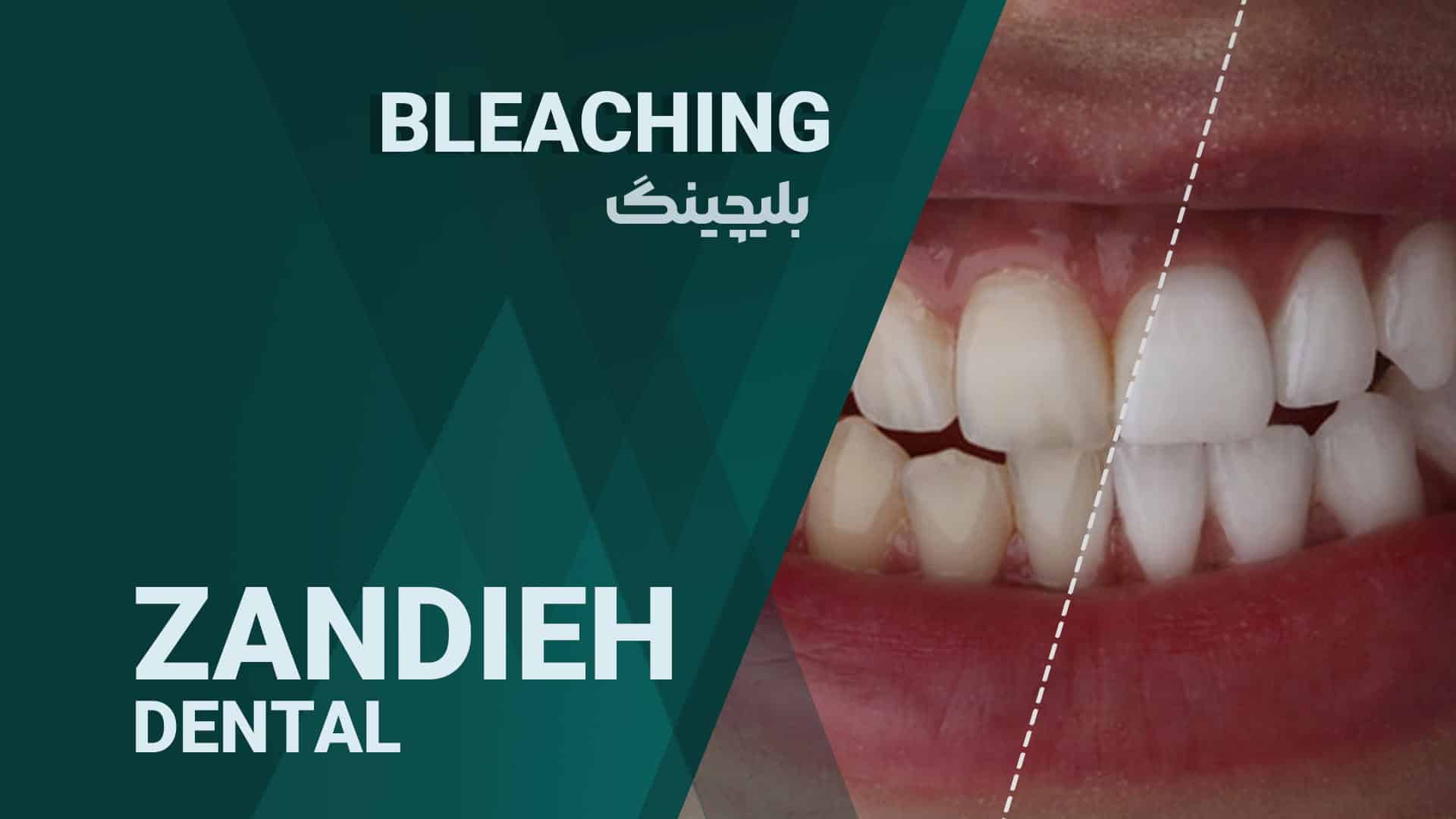 بهترین خدمات بلیچینگ در شیراز