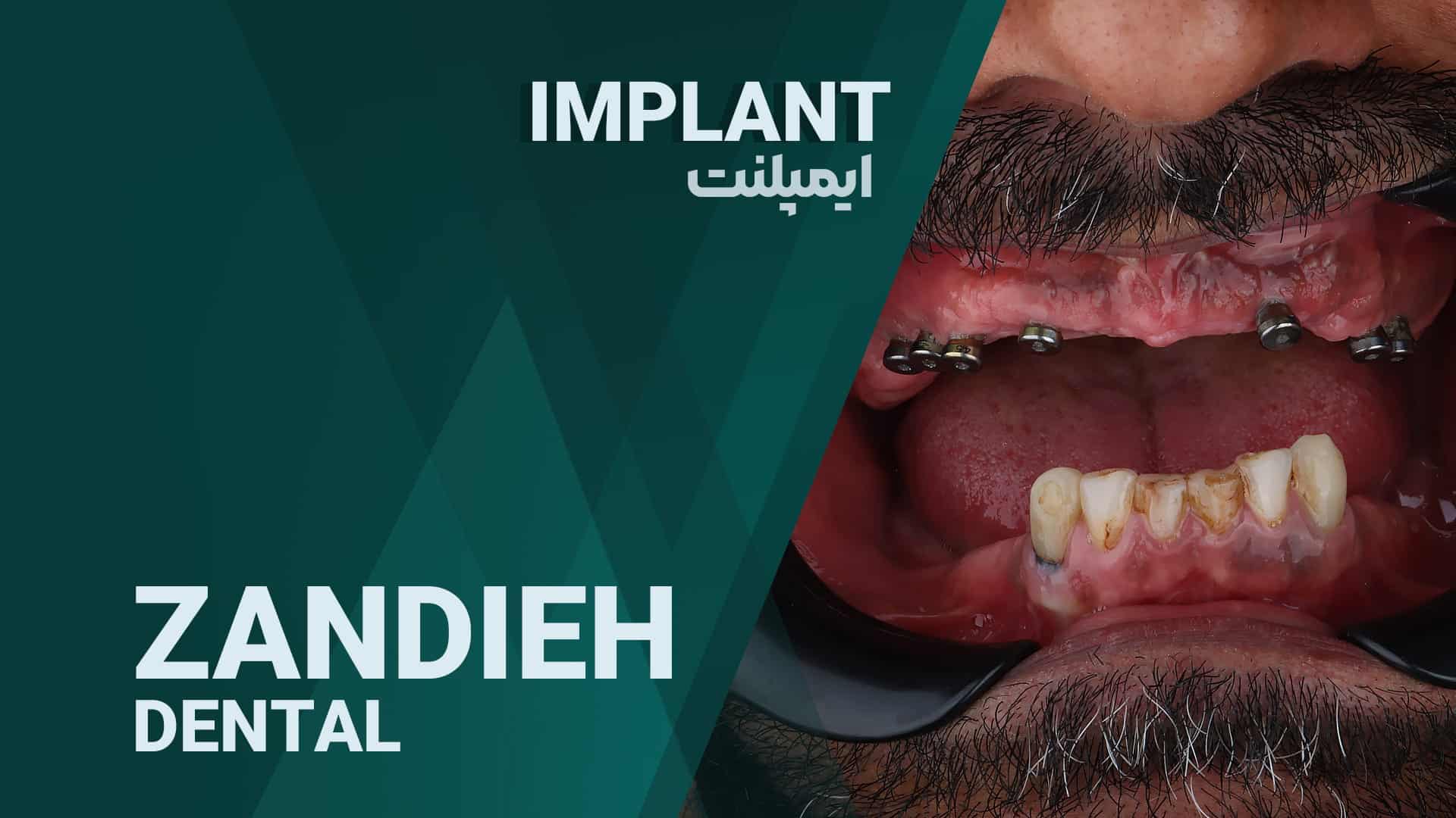 خدمات ایمپلنت دندان در شیراز