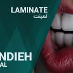لمینت دندان کلینیک زندیه شیراز