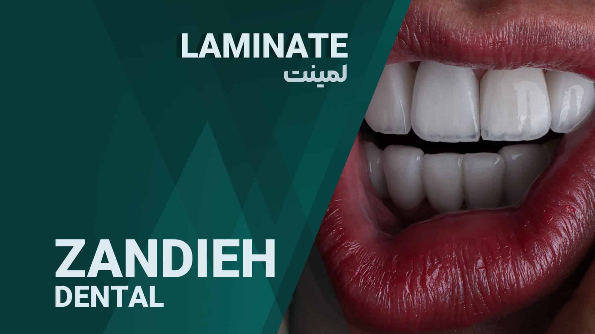 خدمات لمینت دندان در شیراز