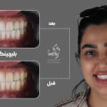 نمونه کار بلیچینگ دندان 033