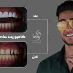 نمونه کار کامپوزیت دندان کلینیک زندیه 104