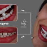 نمونه کار کامپوزیت دندان کلینیک زندیه 100