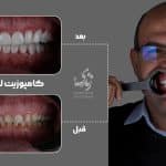 نمونه کار کامپوزیت لیرینگ کلینیک زندیه 107
