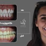 نمونه کار کامپوزیت لیرینگ کلینیک زندیه 106